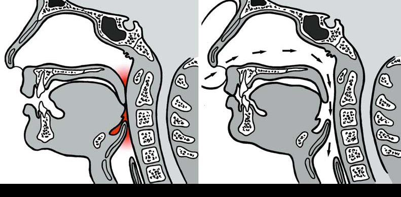 Síndrome de Apnea del Sueño